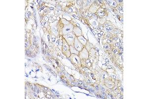 Immunohistochemistry of paraffin-embedded human esophageal cancer using SEMF Rabbit pAb (ABIN6132835, ABIN6147521, ABIN6147522 and ABIN6214683) at dilution of 1:200 (40x lens). (SEMA4F anticorps  (AA 280-420))