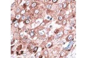 IHC analysis of FFPE hepatocarcinoma cancer tissue stained with the Bak antibody
