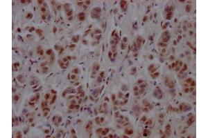 IHC image of ABIN7127781 diluted at 1:100 and staining in paraffin-embedded human breast cancer performed on a Leica BondTM system.
