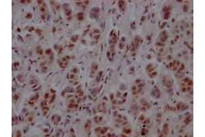 IHC image of ABIN7127781 diluted at 1:100 and staining in paraffin-embedded human breast cancer performed on a Leica BondTM system. (Recombinant PTBP1 anticorps)