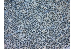 Immunohistochemical staining of paraffin-embedded Carcinoma of pancreas tissue using anti-STAT1mouse monoclonal antibody. (STAT1 anticorps)