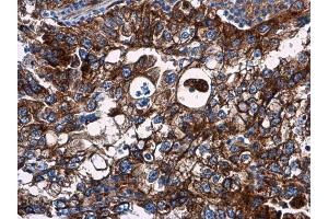 IHC-P Image VCAM1 / CD106 antibody detects VCAM1 / CD106 protein at cell membrane in human endometrial carcinoma by immunohistochemical analysis. (VCAM1 anticorps)