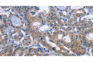Immunohistochemistry of paraffin-embedded Human thyroid cancer tissue using UCK1 Polyclonal Antibody at dilution 1:50 (UCK1 anticorps)