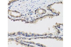Immunohistochemistry of paraffin-embedded Human prostate using PLA2G7 Polyclonal Antibody at dilution of 1:100 (40x lens). (PLA2G7 anticorps)