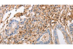 Immunohistochemistry of paraffin-embedded Human colon cancer using INA Polyclonal Antibody at dilution of 1:50