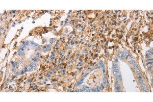 Immunohistochemistry of paraffin-embedded Human colon cancer using INA Polyclonal Antibody at dilution of 1:50 (INA anticorps)
