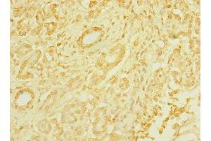 Immunohistochemistry of paraffin-embedded human pancreatic cancer using ABIN7171535 at dilution of 1:100 (TAS1R3 anticorps  (AA 400-570))