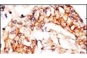 Formalin-fixed and paraffin-embedded human breast carcinoma reacted with anti-PBP1 Antibody (C-term), which was peroxidase-conjugated to the secondary antibody, followed by DAB staining. (NAE1 anticorps  (C-Term))