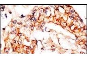 Formalin-fixed and paraffin-embedded human breast carcinoma reacted with anti-PBP1 Antibody (C-term), which was peroxidase-conjugated to the secondary antibody, followed by DAB staining.