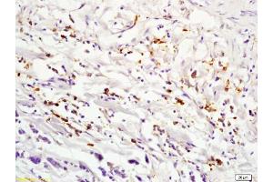 Formalin-fixed and paraffin embedded human lung carcinoma labeled with Anti-IL2RA Polyclonal Antibody, Unconjugated (ABIN670371) at 1:200 followed by conjugation to the secondary antibody and DAB staining