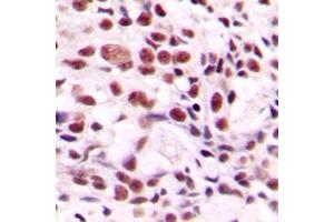 Immunohistochemical analysis of CstF-64 staining in human breast cancer formalin fixed paraffin embedded tissue section.