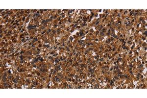 Immunohistochemistry of paraffin-embedded Human liver cancer tissue using MAGEC2 Polyclonal Antibody at dilution 1:40