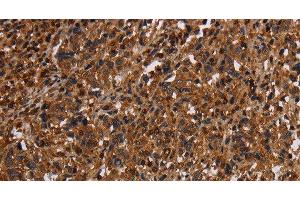 Immunohistochemistry of paraffin-embedded Human liver cancer tissue using MAGEC2 Polyclonal Antibody at dilution 1:40 (MAGEC2 anticorps)