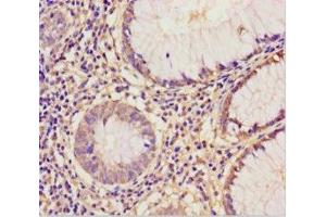 Immunohistochemistry of paraffin-embedded human colon cancer using ABIN7152221 at dilution of 1:100 (EIF6 anticorps  (AA 1-245))