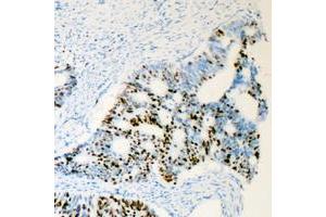 Immunohistochemical analysis of Androgen Receptor (pS650) staining in human prostate cancer formalin fixed paraffin embedded tissue section.