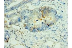 Immunohistochemistry of paraffin-embedded human colon cancer using ABIN7160825 at dilution of 1:100