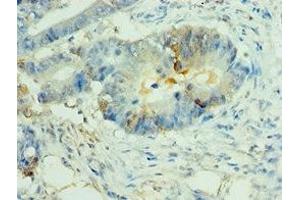 Immunohistochemistry of paraffin-embedded human colon cancer using ABIN7160825 at dilution of 1:100 (NLRP2 anticorps  (AA 1-220))