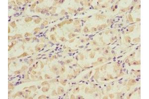 Immunohistochemistry of paraffin-embedded human gastric cancer using ABIN7149377 at dilution of 1:100 (NT5C3 anticorps  (AA 37-336))