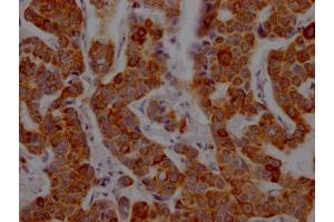 IHC image of ABIN7127409 diluted at 1:100 and staining in paraffin-embedded human breast cancer performed on a Leica BondTM system.