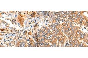 Immunohistochemistry of paraffin-embedded Human liver cancer tissue using MARK2 Polyclonal Antibody at dilution of 1:35(x200) (MARK2 anticorps)