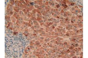 Detection of C1qA in Human Liver Cancer Tissue using Polyclonal Antibody to Complement Component 1, Q Subcomponent A (C1qA)
