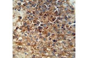CD46 antibody immunohistochemistry analysis in formalin fixed and paraffin embedded human hepatocarcinoma.