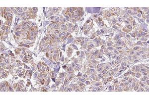 ABIN6278894 at 1/100 staining Human Melanoma tissue by IHC-P. (IL17C anticorps  (Internal Region))