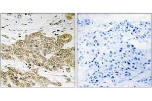 Immunohistochemistry analysis of paraffin-embedded human breast carcinoma, using p53 (Phospho-Ser6) Antibody. (p53 anticorps  (pSer6))