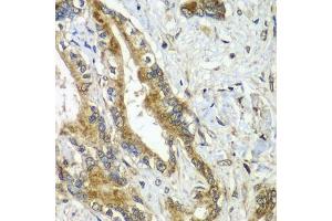 Immunohistochemistry of paraffin-embedded human liver cancer using CDC16 antibody  at dilution of 1:100 (40x lens). (CDC16 anticorps  (AA 371-620))