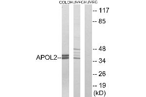 Immunohistochemistry analysis of paraffin-embedded human cervix carcinoma tissue using APOL2 antibody. (Apolipoprotein L 2 anticorps)