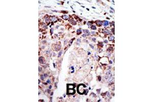 Formalin-fixed and paraffin-embedded human cancer tissue reacted with ATXN3 polyclonal antibody  , which was peroxidase-conjugated to the secondary antibody, followed by AEC staining. (Ataxin 3 anticorps  (AA 29-59))
