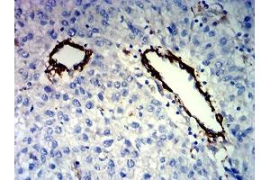 Immunohistochemical analysis of paraffin-embedded liver cancer tissues using FLI1 mouse mAb with DAB staining.