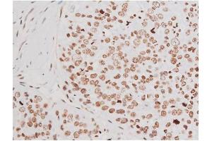 ABIN6267601 at 1/200 staining Human liver cancer tissue sections by IHC-P.