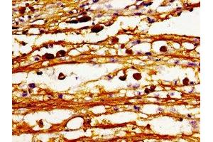 Immunohistochemistry of paraffin-embedded human melanoma using ABIN7147475 at dilution of 1:100