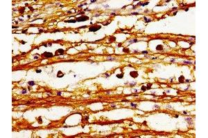 Immunohistochemistry of paraffin-embedded human melanoma using ABIN7147475 at dilution of 1:100 (CERS6 anticorps  (AA 324-392))