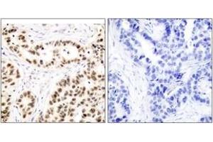 Immunohistochemistry analysis of paraffin-embedded human breast carcinoma tissue, using Elk1 (Ab-417) Antibody. (ELK1 anticorps  (AA 379-428))