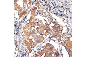Immunohistochemistry of paraffin-embedded human lung cancer using eIF2C3 Rabbit mAb (ABIN7267039) at dilution of 1:100 (40x lens). (EIF2C3 anticorps)