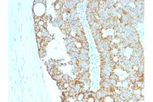 Formalin-fixed, paraffin-embedded human Colon Carcinoma stained with MAML2 Monoclonal Antibody (MAML2/1302).