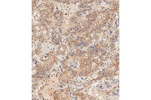 Immunohistochemical analysis of paraffin-embedded Human thyroid carcinoma tissue using B performed on the Leica® BOND RXm. (DLL3 anticorps  (C-Term))