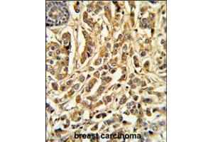 Formalin-fixed and paraffin-embedded human breast carcinoma reacted with CYP21A2 Antibody , which was peroxidase-conjugated to the secondary antibody, followed by DAB staining.