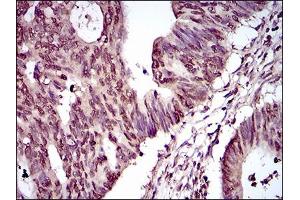 Immunohistochemical analysis of paraffin-embedded rectum cancer tissues using PIWIL4 mouse mAb with DAB staining. (PIWIL4 anticorps  (AA 304-434))