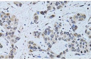 Immunohistochemistry of paraffin-embedded Human liver cancer using SIN3A Polyclonal Antibody at dilution of 1:100 (40x lens).