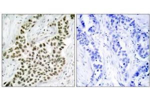 Immunohistochemical analysis of paraffin- embedded human breast carcinoma tissue using Histone H2A. (H2AFX anticorps)