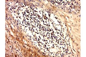 Paraformaldehyde-fixed, paraffin embedded human cervical carcinoma tissue, Antigen retrieval by boiling in sodium citrate buffer(pH6) for 15min, Block endogenous peroxidase by 3% hydrogen peroxide for 30 minutes, Blocking buffer (normal goat serum) at 37°C for 20min, Antibody incubation with Rabbit Anti-Ack1 (Tyr284) Polyclonal Antibody, Unconjugated  at 1:500 overnight at 4°C, followed by a conjugated secondary and DAB staining