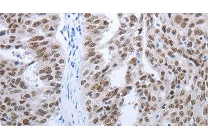 Immunohistochemistry of paraffin-embedded Human ovarian cancer tissue using RBMS1 Polyclonal Antibody at dilution 1:30 (RBMS1 anticorps)
