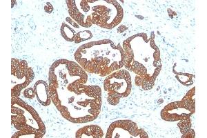 Formalin-fixed, paraffin-embedded human Colon Carcinoma stained with Cytokeratin 18 Mouse Monoclonal Antibody (DE-K18). (Cytokeratin 18 anticorps)