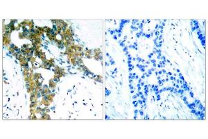 Immunohistochemical analysis of paraffin-embedded human breast carcinoma tissue, using PAK1/PAK2/PAK3 (Ab-423/402/421) antibody (E021169). (PAK1/2/3 anticorps)