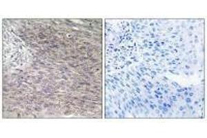 Immunohistochemistry analysis of paraffin-embedded human cervix carcinoma tissue using CHSS2 antibody. (CHPF anticorps)