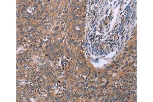 Immunohistochemistry of Human ovarian cancer using CSF2RB Polyclonal Antibody at dilution of 1:40 (CD131 anticorps)