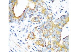 Immunohistochemistry of paraffin-embedded Human stomach using MTCO2 Polyclonal Antibody at dilution of 1:100 (40x lens). (COX2 anticorps)